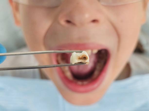 Best Emergency Tooth Extraction in Brodheadsville, PA